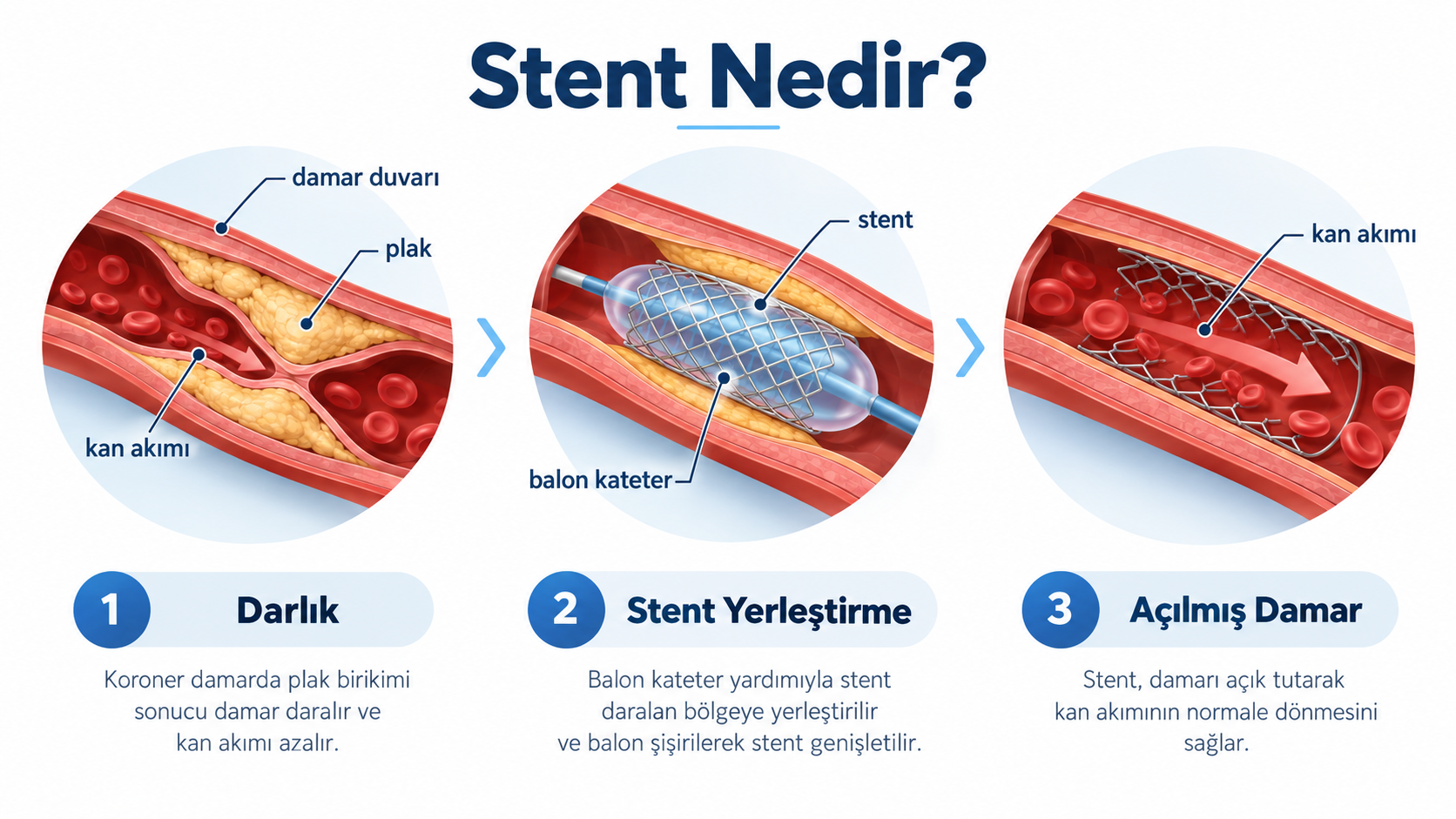 Stent yerleştirme sürecini gösteren tıbbi bilgilendirme grafiği